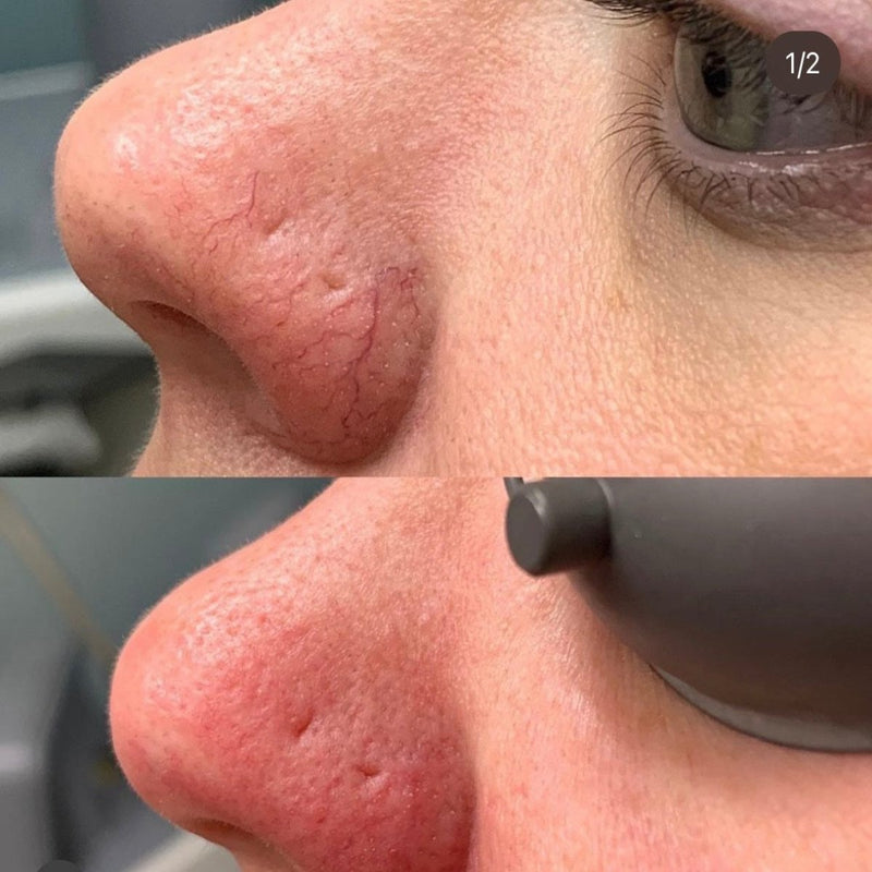 VBeam - Laser Treatments