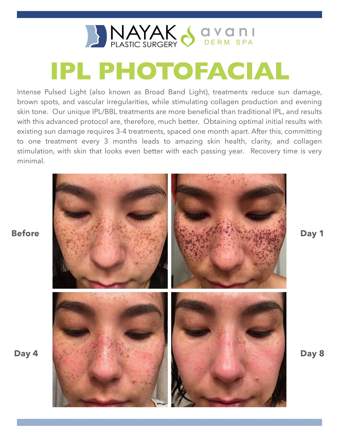 IPL: 1 Treatment to Hands
