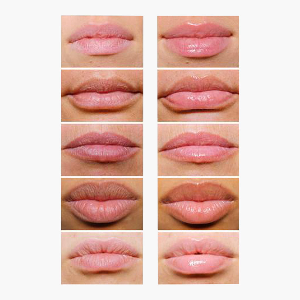Lipsmart - Nayak Plastic Surgery - 2